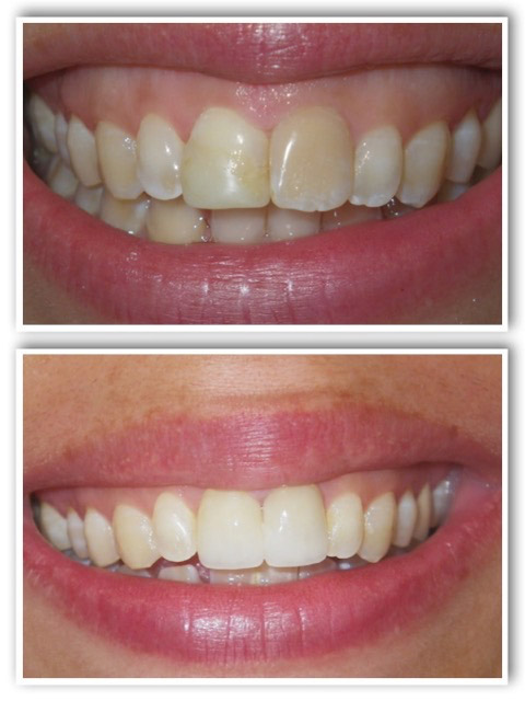 Dentistry Before and After Photos | La Jolla Dentist