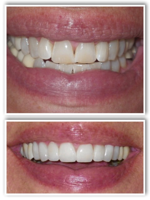 Dentistry Before and After Photos | La Jolla Dentist